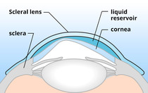 How scleral lenses fit